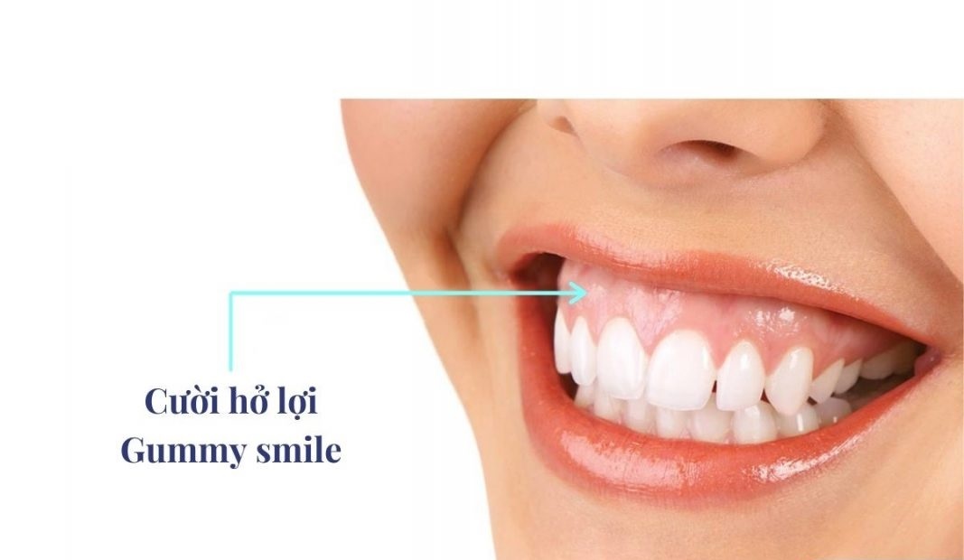 Hở lợi là gì? Nguyên nhân, mức độ và phương pháp điều trị hiệu quả